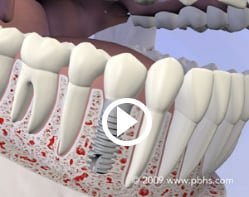 Dental Implants Presentation