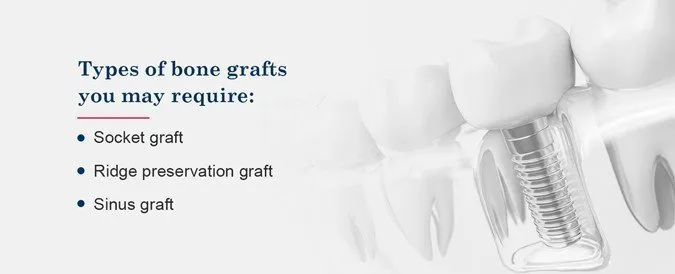 Bone grafting infographic